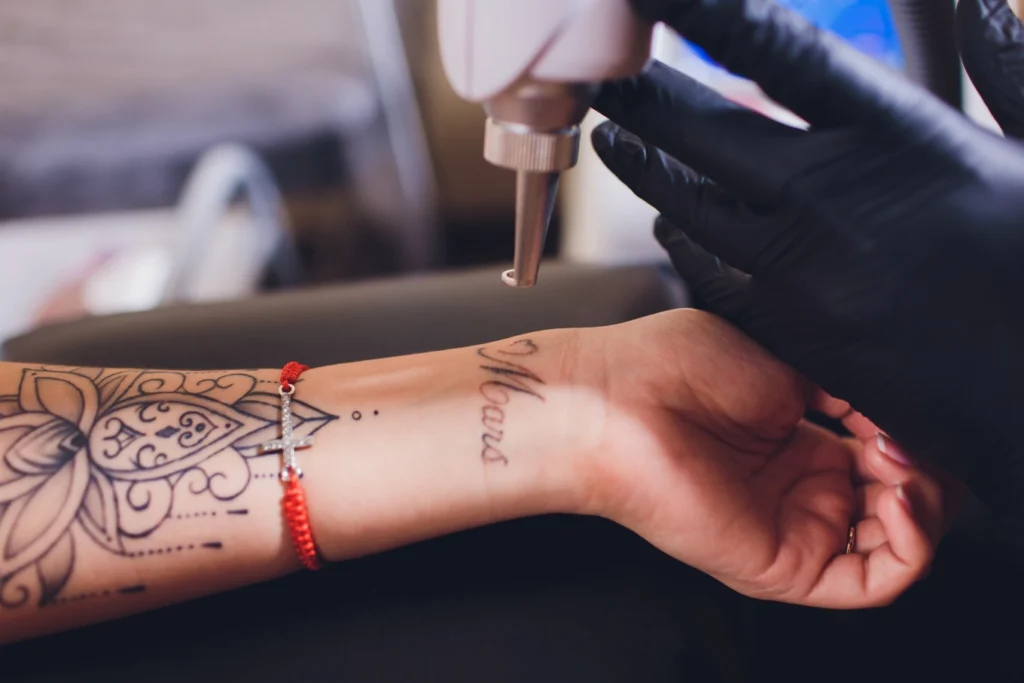 Tattoo Removal in Tulsa, OK | Aging Backwards Med Spa